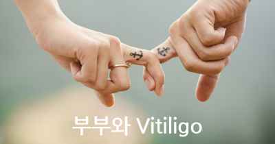 부부와 Vitiligo