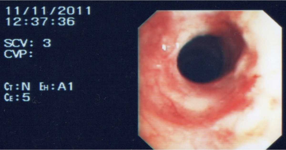 Story about Relapsing Polychondritis