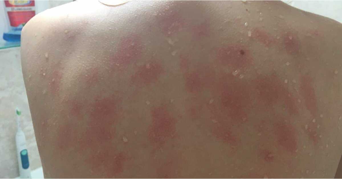 Story about Aquagenic urticaria