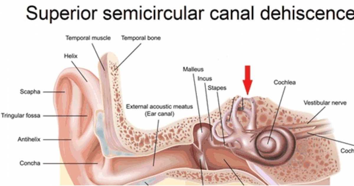 Interview Semicircular canal dehiscence syndrome