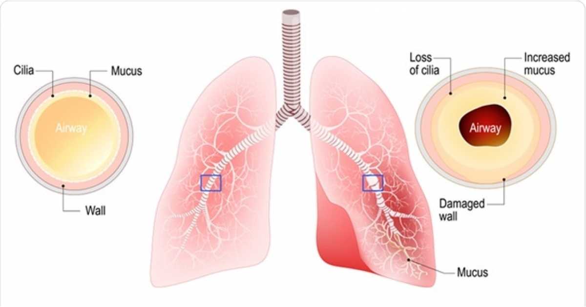 Histoire au sujet de Bronchiectasie