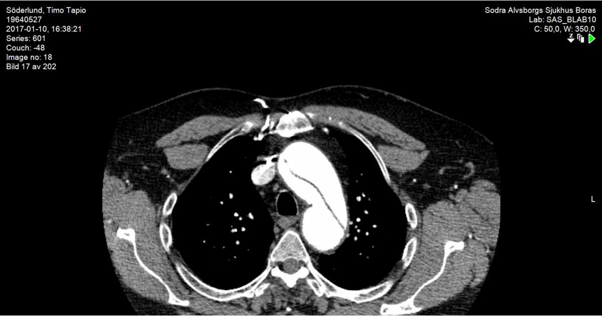 Story about Aortic Dissection